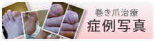 巻き爪補正症例集