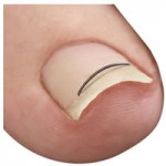 超弾性ワイヤー法